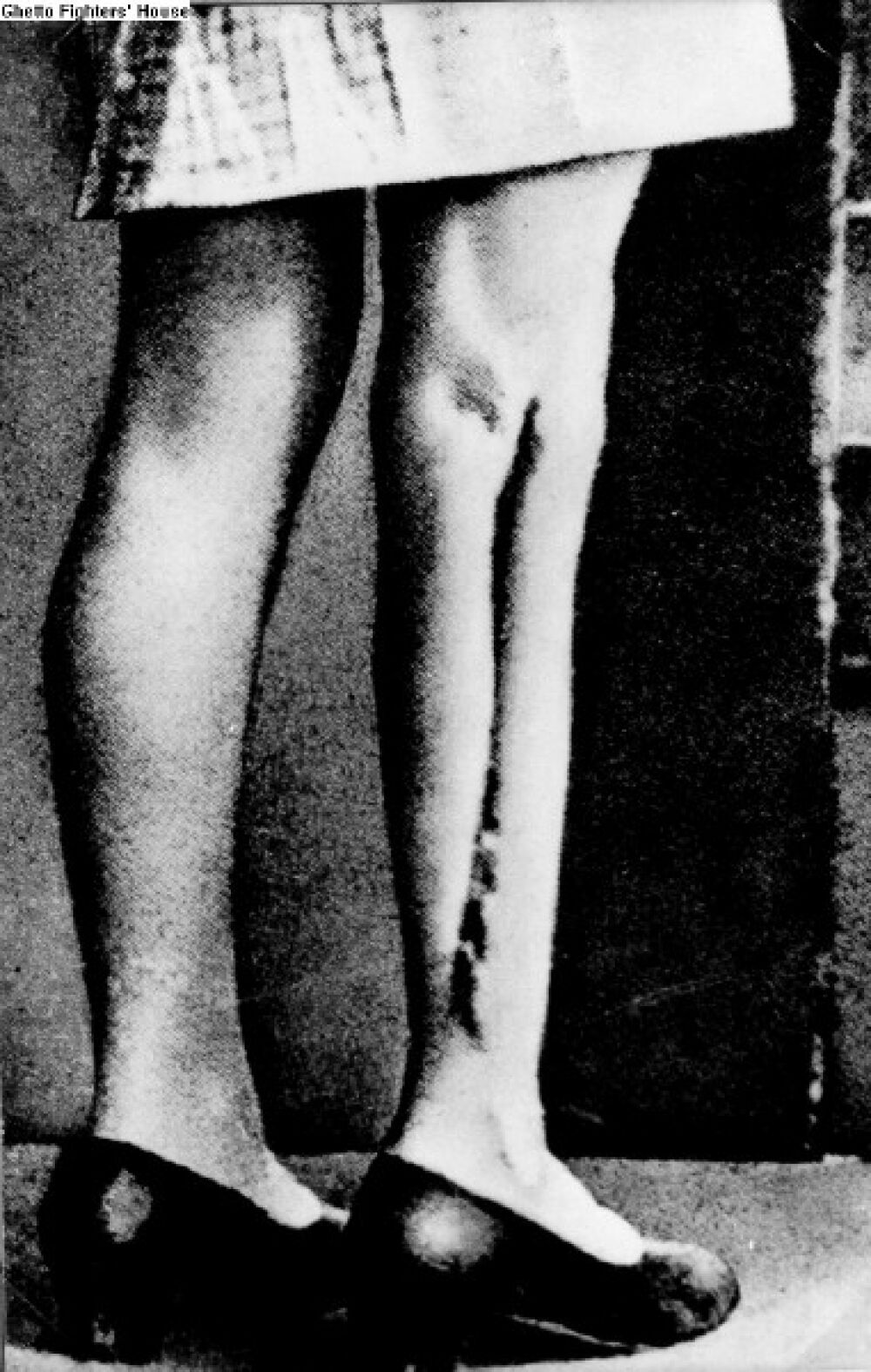 Foto verletzter Beine, an denen Ärzt/-innen Experimente vorgenommen hatten. Das Bild wurden unmittelbar nach dem Krieg aufgenommen. Zofia selbst entkam den Operationen nur knapp: Sie war für die Experimente schon vorgesehen, doch bis auf ein paar Spritzen wurde ihr kein Leid zugefügt.